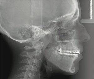Black and white Cephalometric X-Ray