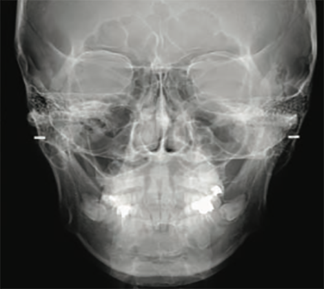 Black and white Cephalometric PA X-Ray
