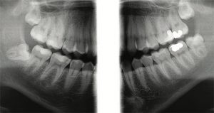 Bitewing image view from X-Ray