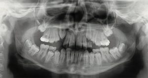 Pediatric Panoramic X-Ray