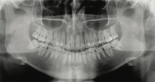 standard adult panoramic image X-Ray