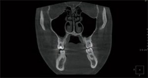Black and white 3D X-ray from bottom FOV