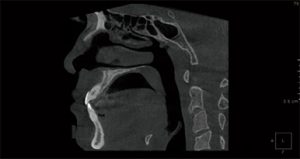 Black and white x-ray from a side FOV